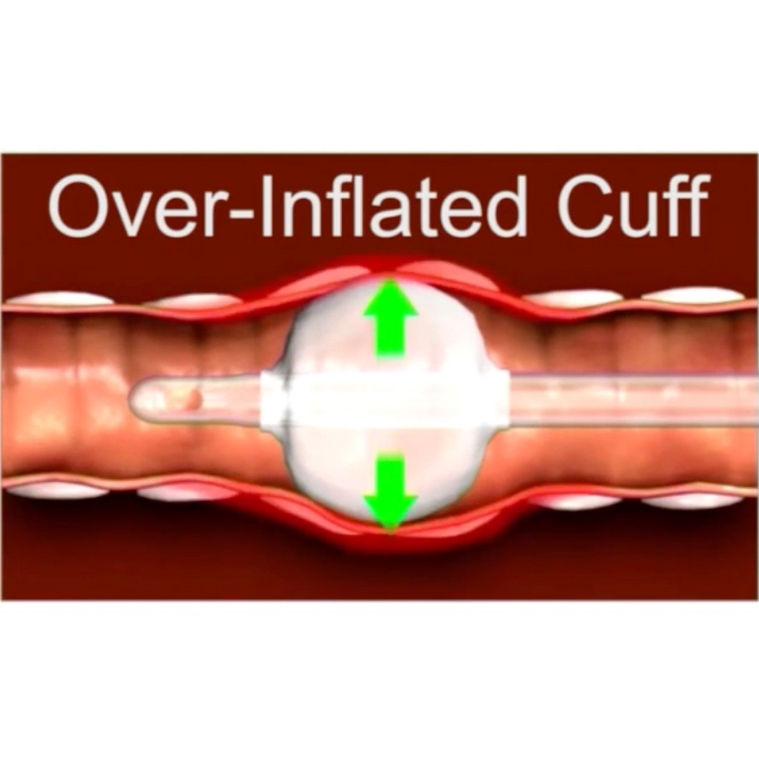 KRUUSE манометр для измерения давления и объёма манжеты эндотрахеальной трубки